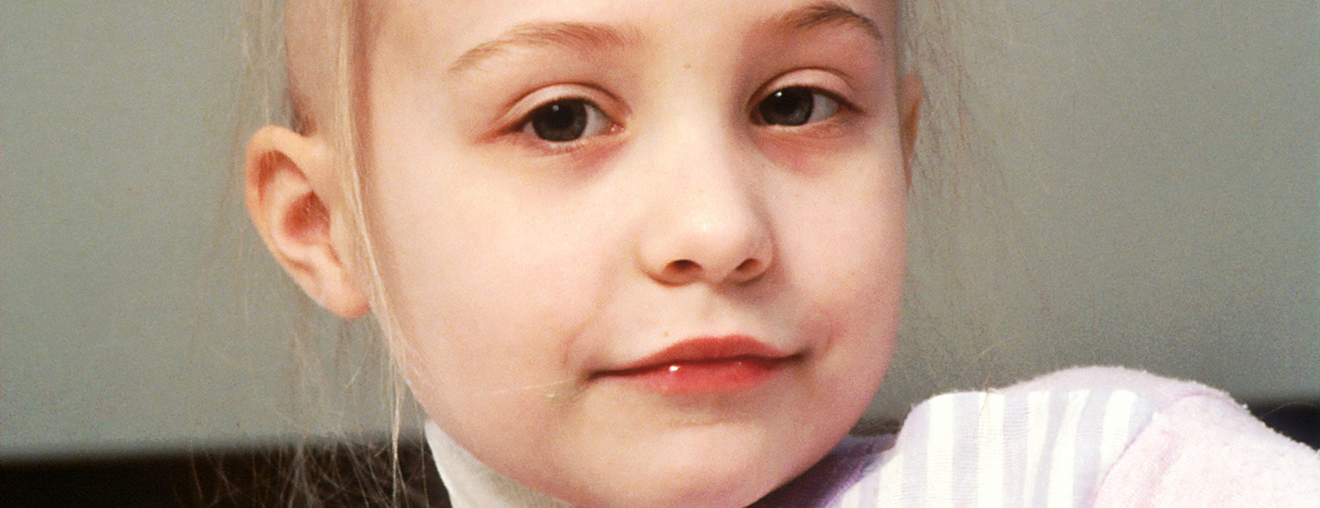 Pieni lapsi, jolla on hiukset lähteneet päästä syöpähoitojen takia.